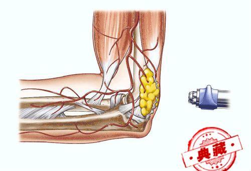 网球肘最佳治疗方法